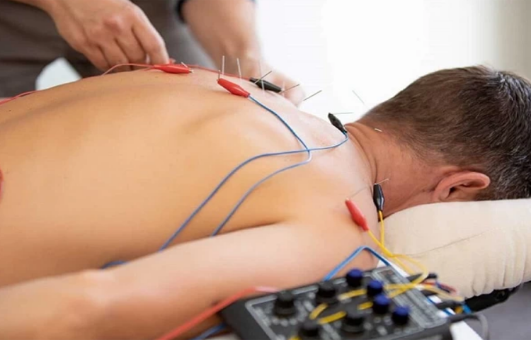 Điện châm điều trị bệnh đám rối thần kinh cánh tay (Chứng nuy, chứng tý)